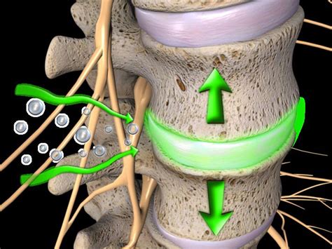 How Spinal Decompression Therapy Works Canberra Spine Centre