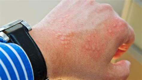 Alergija na koži uzrok simptomi lečenje Simptomi bolesti