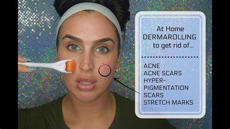 At Home Dermarolling To Get Rid Of Acne Acne Scars Hyper Pigmentation