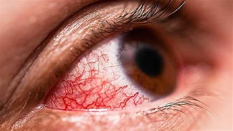 It was first identified in december 2019 in wuhan,. This New Symptom Can Also be Used to Identify Coronavirus ...