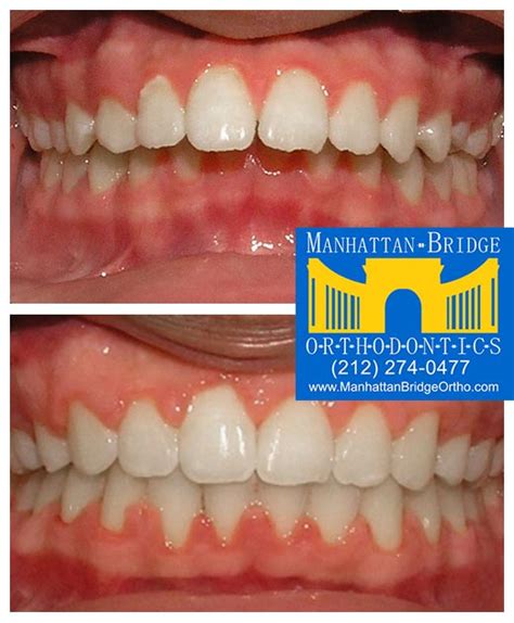 Before And After Overjet Manhattan Bridge Orthodontics