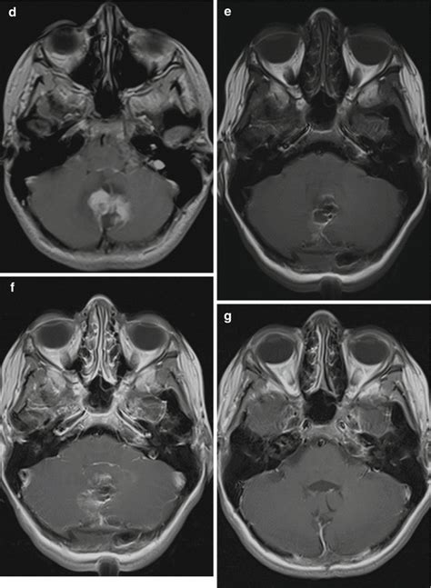 Imaging Guidelines For Pediatric Brain Tumor Patients Radiology Key