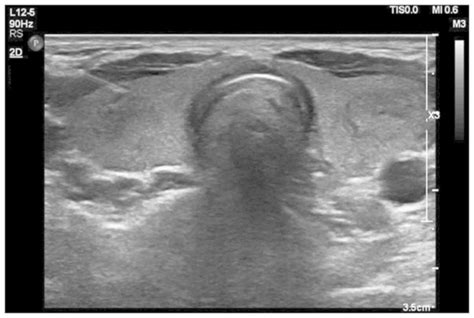 Diagnostic Value Of Fine Needle Aspiration Combined With Ultrasound For