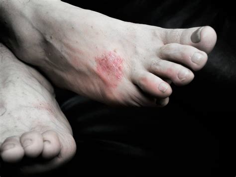 Itchy Feet Causes And Cures