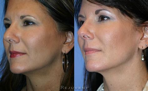 Lower Face Rejuvenation Photos • Rejuvent Medical Spa Scottsdale Liquid Facelift Face Fillers