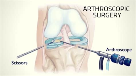 Arthroscopic Surgery Dr Patrick Chin Orthopedic Surgeon Vancouver