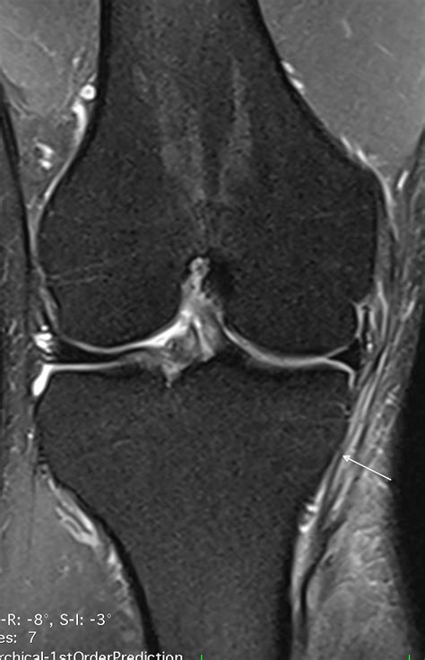 Cureus Grade Iii Distal Medial Collateral Ligament Tear Missed By