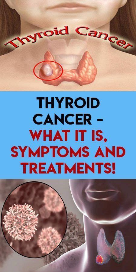 Pin On Cancer Cause Symptoms And Treatment