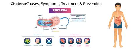 Cholera Causes Symptoms Treatment And Prevention