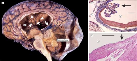 Brain Images Of Our Patient With A Dandy Walker Malformation A