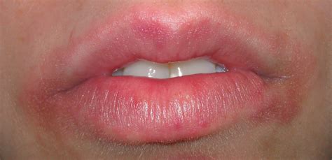 White Spots On Skin That Get Bigger Tiny White Bumps On Lips That Burn