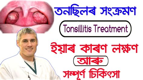Cause And Treatment Of Tonsil Infection How To Get Rid Of Tonsilitis