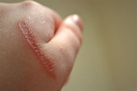A person can get them from hot water, a minor sunburn, or by touching hot metal. Untitled | Flickr - Photo Sharing!