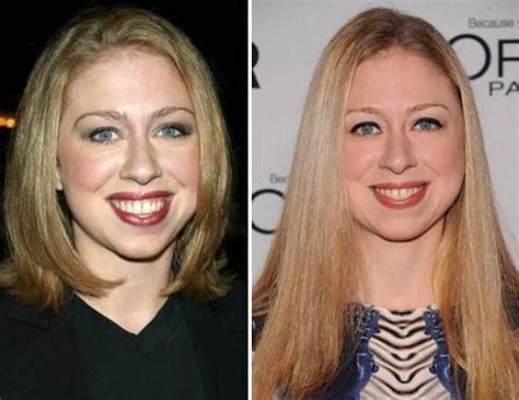 Chelsea Clinton before and after plastic surgery (17 ...