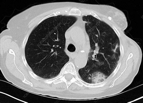 Eosinophilic Pneumonia Ct Scan Stock Image C0366410 Science