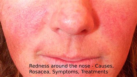 Redness Around The Nose Causes Rosacea Symptoms Treatments