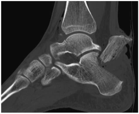 Tenting Skin Fracture And Figure 155 Displaced Extraarticular Tuberosity