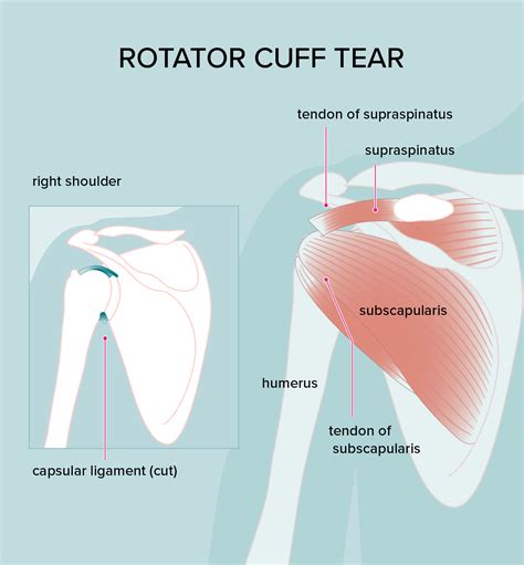 Rotator Cuff Injury Treatments Symptoms And Diagnosis