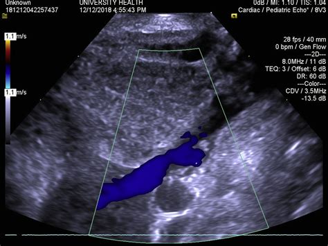 Retroaortic Innominate Vein In Hypoplastic Left Heart Syndrome A Case