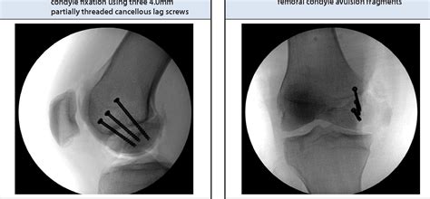 A Novel Technique for Fixation of a Medial Femoral Condyle ...
