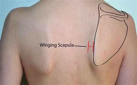 What Is Winged Scapula And How To Fix It Training For Acro T F A