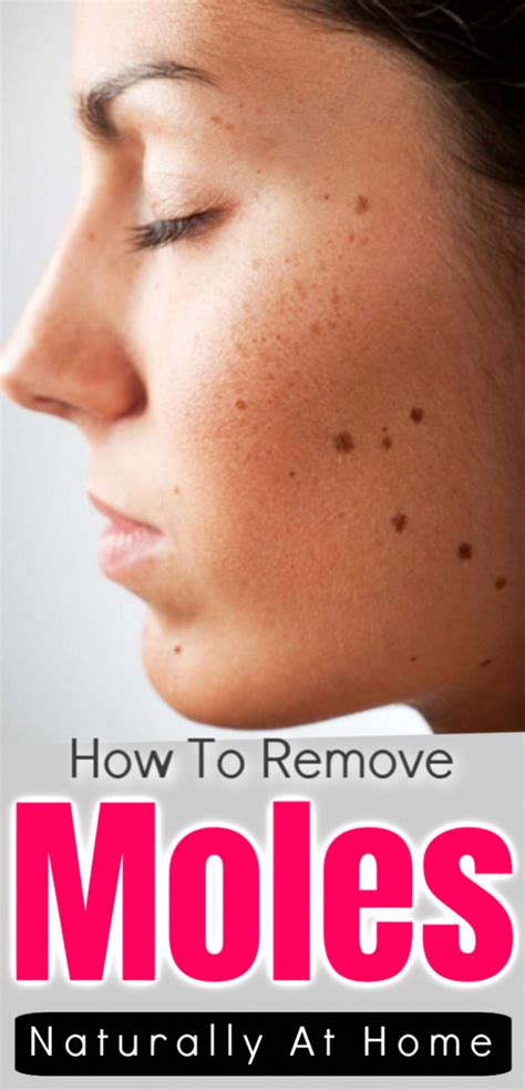 Aug 08, 2017 · so skip the diy mole removal attempt and make an appointment with a dermatologist. How To Remove Skin Tag And Moles At Home With Natural ...