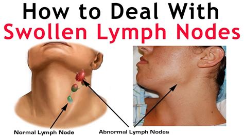 Swollen Glands Or Lymph Nodes With Fibromyalgia And Mecfs Fibromyalgia