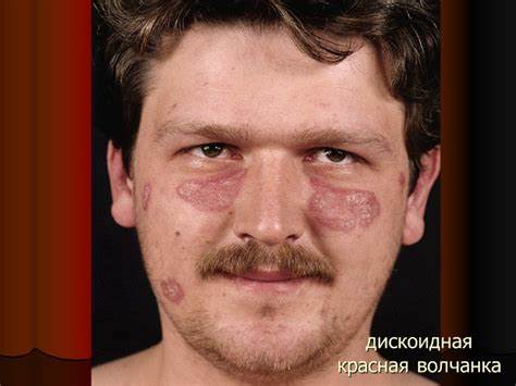 Диета при дискоидной красной волчанки ПОРАЖЕНИЯ КОЖИ ПРИ БОЛЕЗНЯХ СОЕДИНИТЕЛЬНОЙ ТКАНИ Красная волчанка ПОРАЖЕНИЯ КОЖИ ПРИ БОЛЕЗНЯХ СОЕДИНИТЕЛЬНОЙ ТКАНИ Красная волчанка Диета при дискоидной красной волчанки