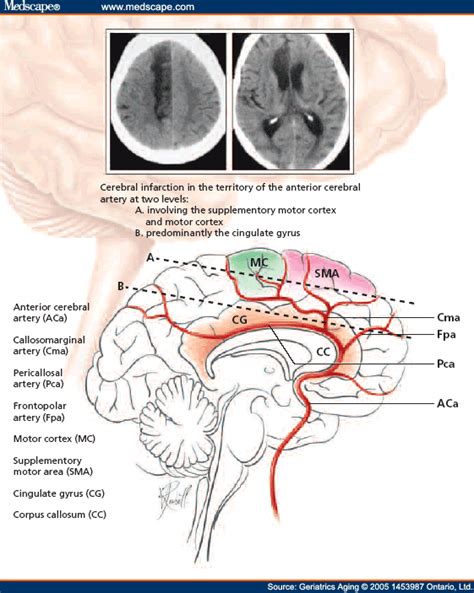 Demonstration Of A Cerebral Infarction In The Territory Of The Anterior