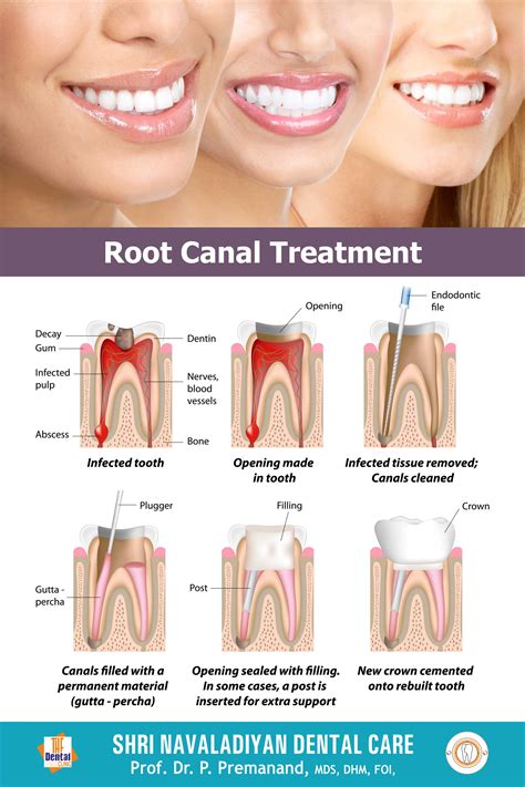 Root Canal Treatment | Shri Navaladiyan Dental Care | The