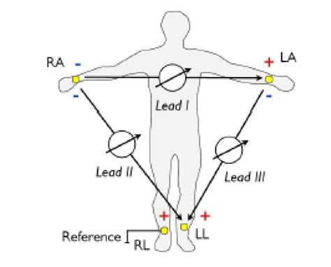 Electrode Position Of The Limb Leads Or Commonly Termed As Single Lead