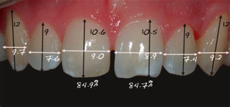 Rode Revista De Operatoria Dental Y Endodoncia Protesis Implantes My Xxx Hot Girl