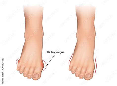 Illustration Of The Normal Foot And Hallux Valgus Human Foot Deformity Hallux Valgus And