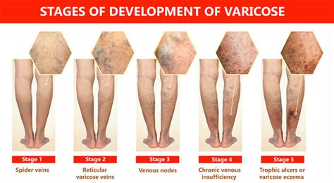 Spider Veins Vs Reticular Veins Whats The Difference