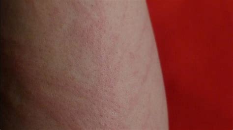 Skin Cancer Rashes Pictures