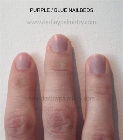 Health Signs From Fingernail Colour Destiny Palmistry