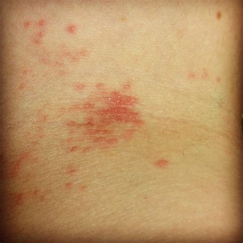 Rash On Inside Of Elbow Pictures Photos