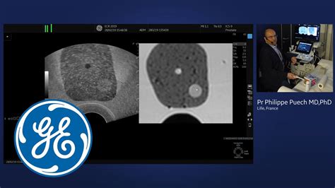 Why And How To Perform Mri Us Fusion Guided Prostate Biopsies Using Ge V Nav Youtube