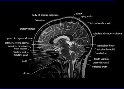 Cross Sectional Anatomy Mri Brain Sagittal Anatomy Free Mri Brain