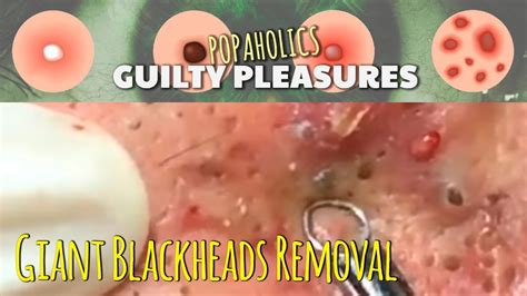 The Most Satisfying Giant Blackheads Removal Blackhead Popping