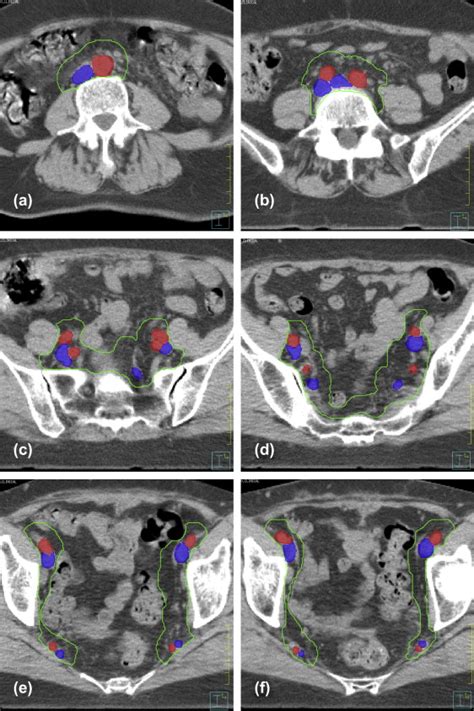 Pelvic Lymph Node Topography For Radiotherapy Treatment Planning From