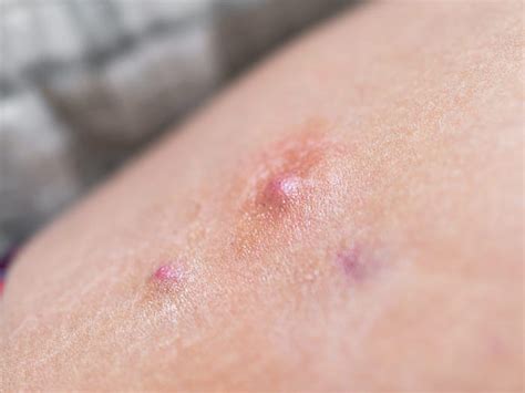 Hidradenitis Suppurativa Symptoms Itchy Lumps Pus On Armpits