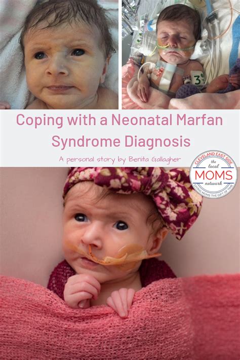 Infantile Marfan Syndrome Life Expectancy Wynona Puente
