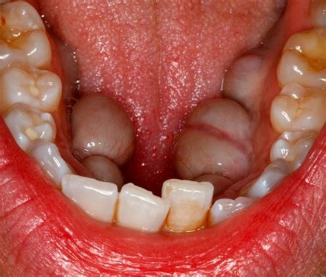 Oral Pathology What Are Mandibular Tori Directorio Odontológico