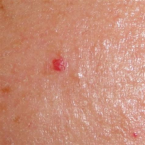 Cherry Angioma Removal Before And After Treating Anigoma Pure