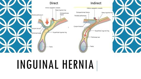 Understanding Hernia Inguinal Hernia Hernia Inguinal Types Of Hernias Images And Photos Finder