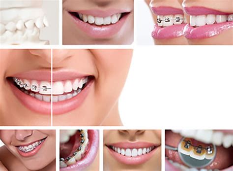 3 Common Types Of Braces Henry Orthodontics Laurinburg North Carolina