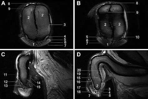 Pdf Surgical Anatomy Of The Penis In Hypospadias Magnetic Resonance