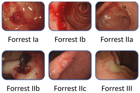 Gastric Ulcer Classification Hot Sex Picture