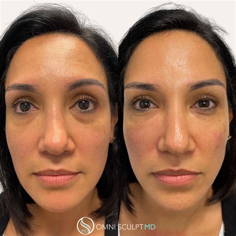 Under Eye Filler Before And After Gallery Omni Sculpt Md